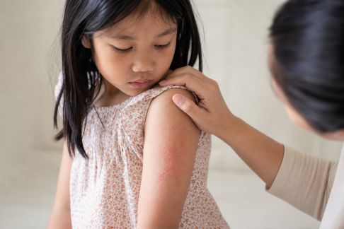 Comprendre l’eczéma chez l’enfant et apaiser ses crises